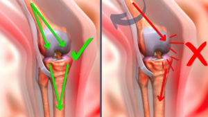 How Cow Hock posture overloads the medial aspect of the articular cartilage and medial meniscus in the stifle.