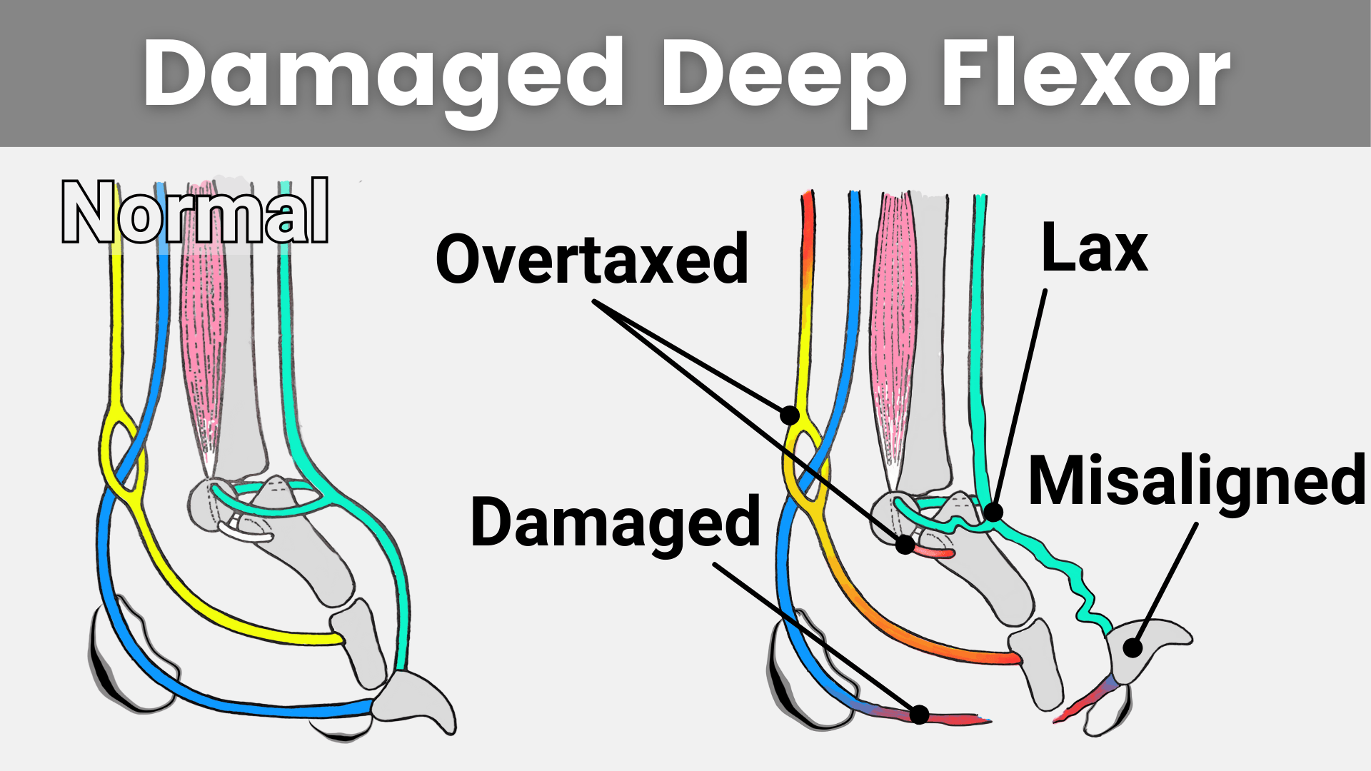 Anatomy graphic showing how a Sprung Toe is actually a damaged Deep Digital Flexor Tendon.