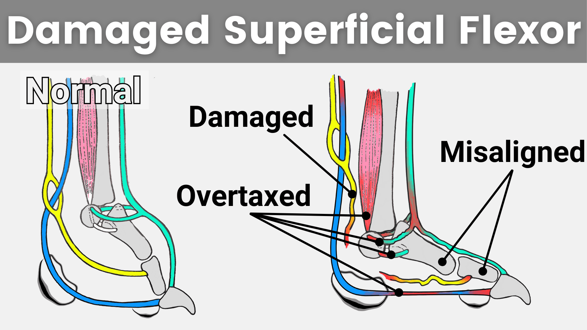 Graphic showing the anatomical difference between a normal canine foot, and a foot with a damages superficial digital flexor.