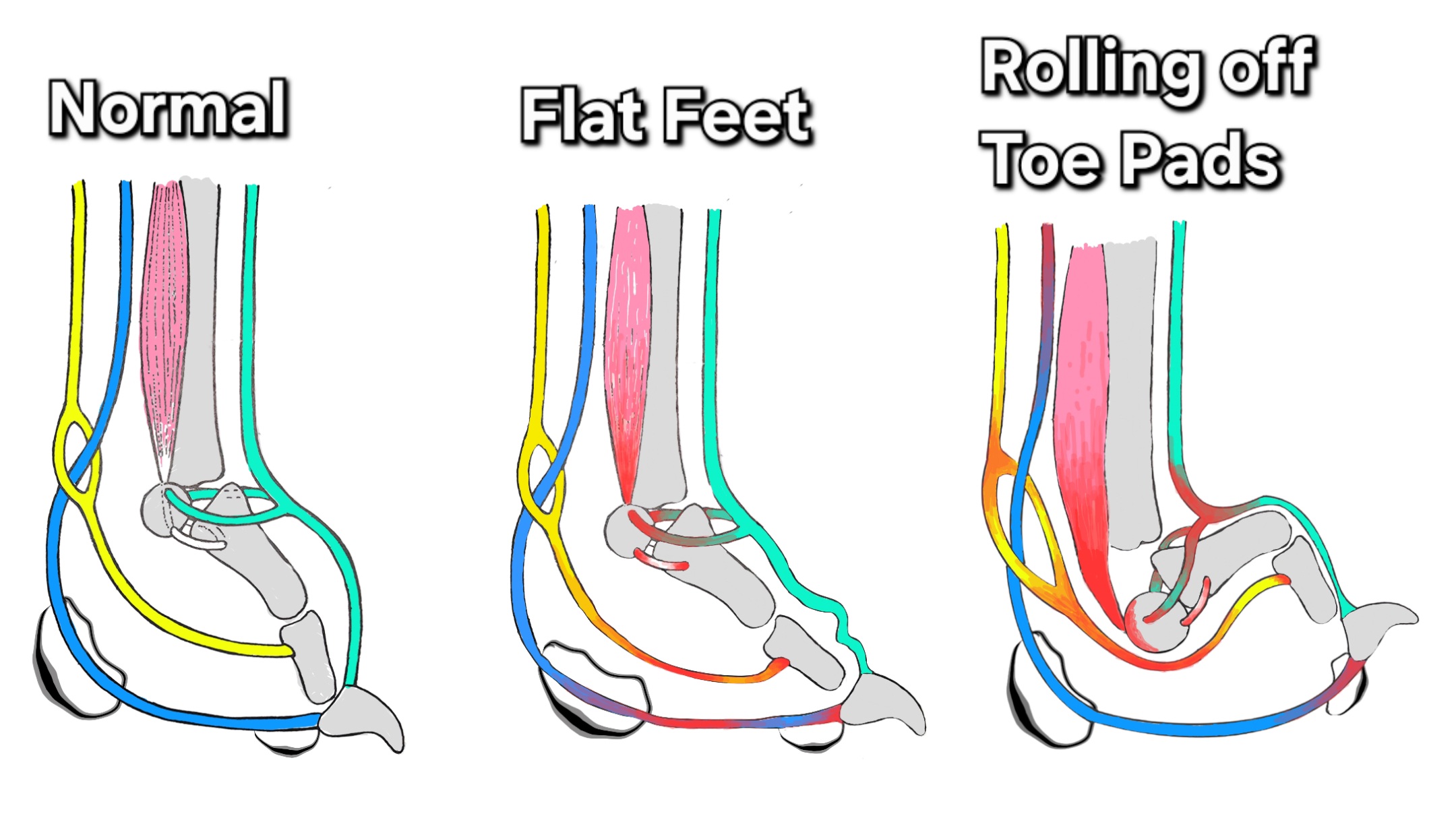 Postural Deviations: Normal Foot, Flat Feet, Rolling off Toe Pads